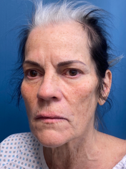 Facelift and Necklift Before & After Patient #12890