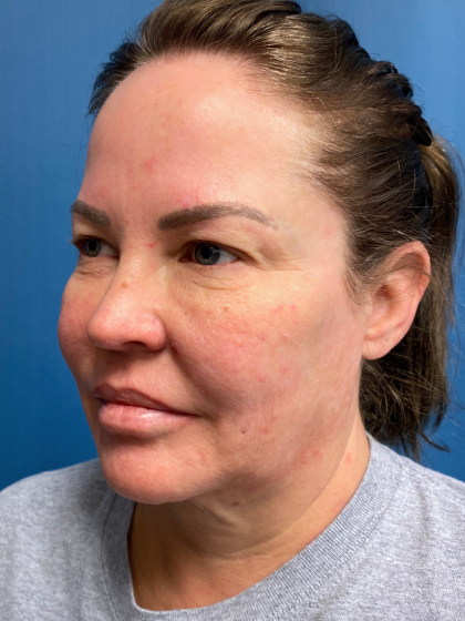 Forehead Reduction Before & After Patient #12938