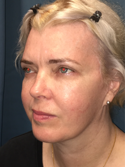 Facelift and Necklift Before & After Patient #13012
