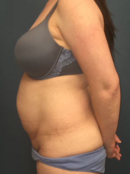 Tummy Tuck Before & After Patient #13015