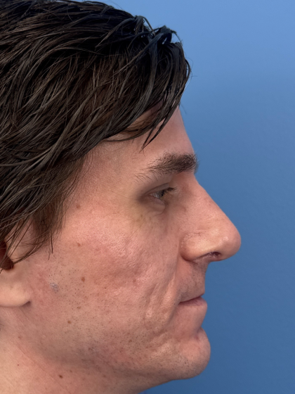 Rhinoplasty Before & After Patient #12901