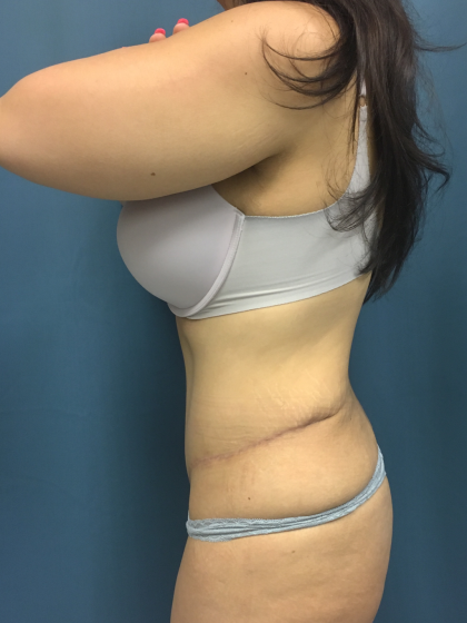 Tummy Tuck Before & After Patient #13016