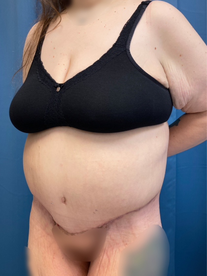 Massive Weight Loss Before & After Patient #13508