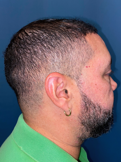 NeoGraft Before & After Patient #12914