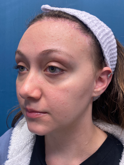 Forehead Reduction Before & After Patient #12935