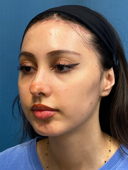 Forehead Reduction Before & After Patient #12936