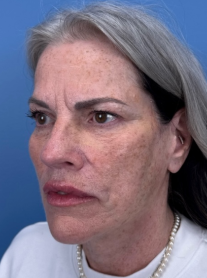 Facelift and Necklift Before & After Patient #12890