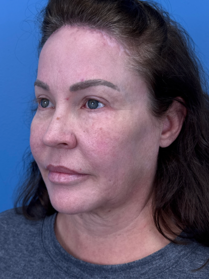 Forehead Reduction Before & After Patient #12938
