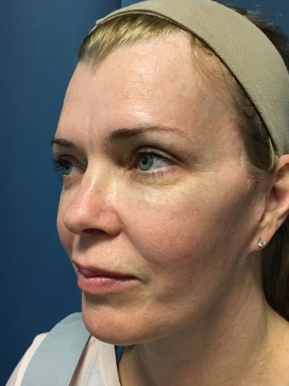 Facelift and Necklift Before & After Patient #13012