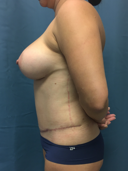 Mommy Makeover Before & After Patient #13014