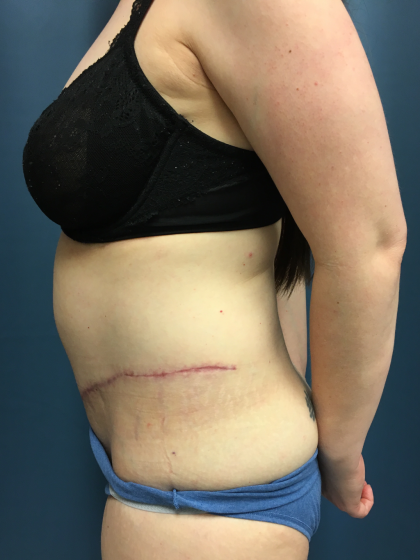 Tummy Tuck Before & After Patient #13015
