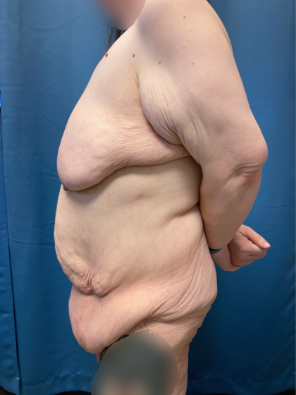 Massive Weight Loss Before & After Patient #13508