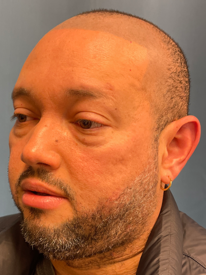 NeoGraft Before & After Patient #12914