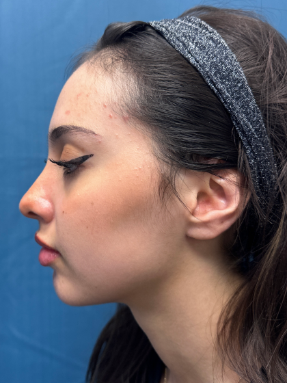 Forehead Reduction Before & After Patient #12936