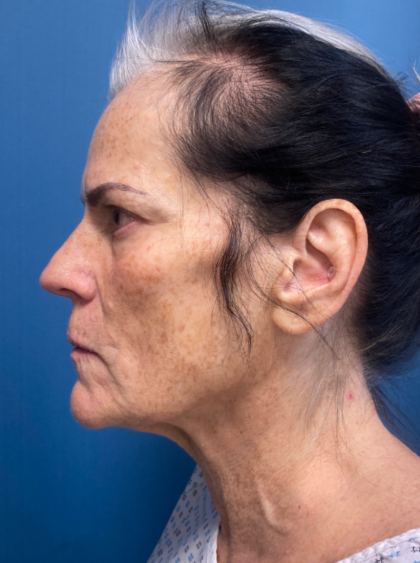 Facelift and Necklift Before & After Patient #12890