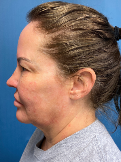 Forehead Reduction Before & After Patient #12938