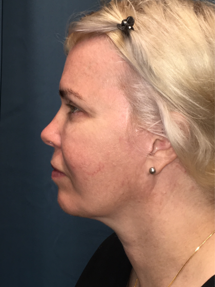 Facelift and Necklift Before & After Patient #13012