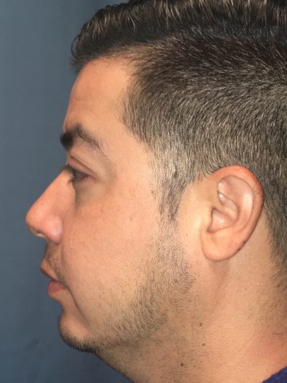 Chin Implant Before & After Patient #13160