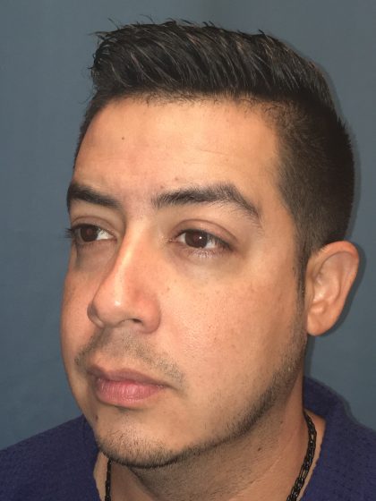Chin Implant Before & After Patient #13160