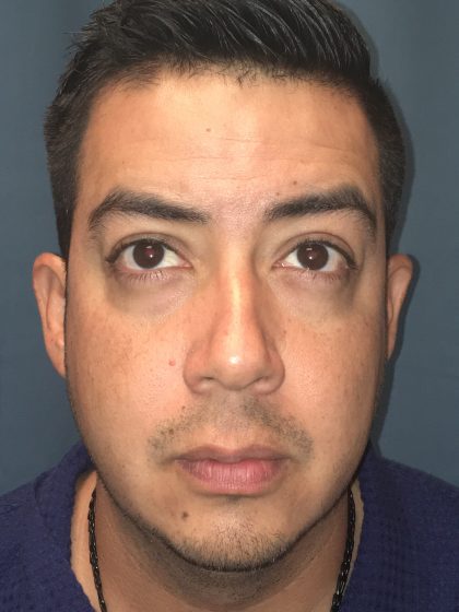 Chin Implant Before & After Patient #13160