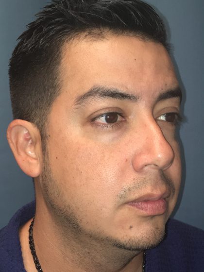 Chin Implant Before & After Patient #13160