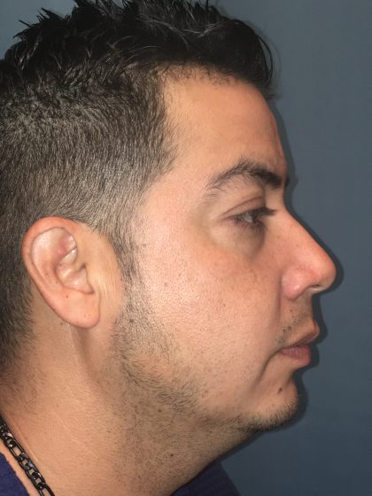 Chin Implant Before & After Patient #13160