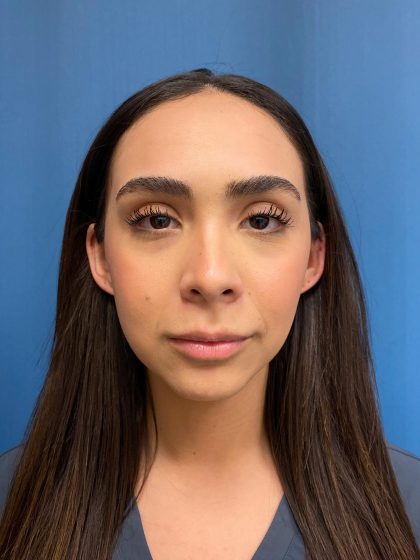 Lip Lift Before & After Patient #13215
