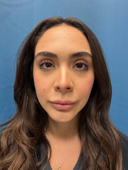 Lip Lift Before & After Patient #13215