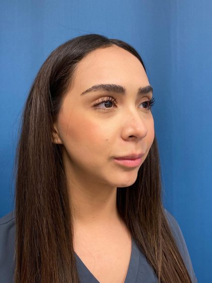 Lip Lift Before & After Patient #13215