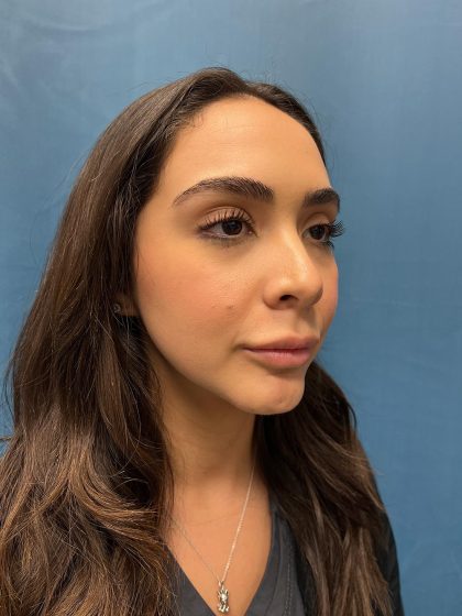 Lip Lift Before & After Patient #13215
