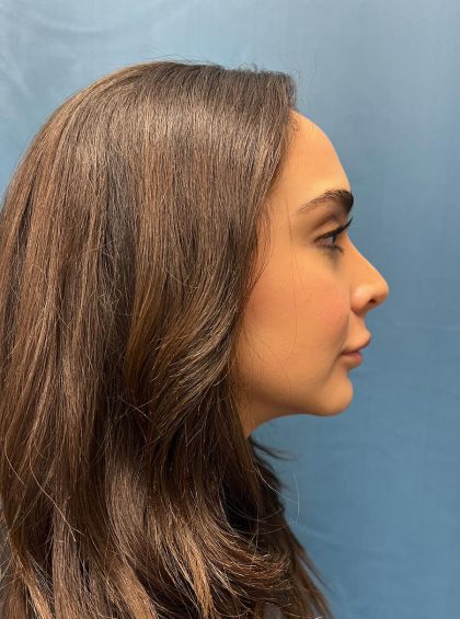 Lip Lift Before & After Patient #13215