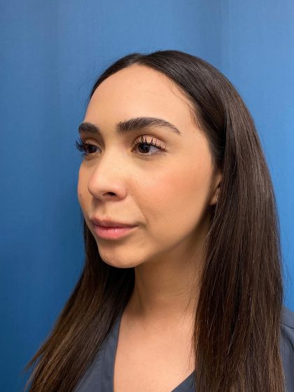 Lip Lift Before & After Patient #13215