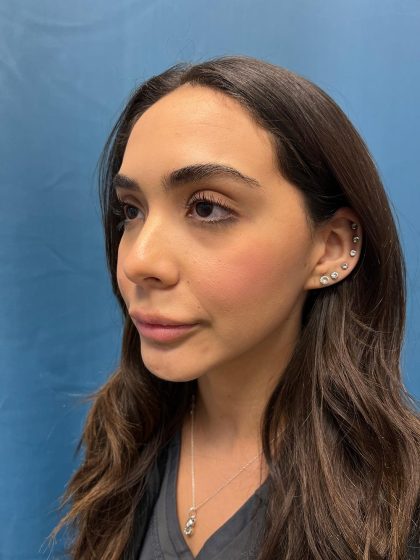 Lip Lift Before & After Patient #13215