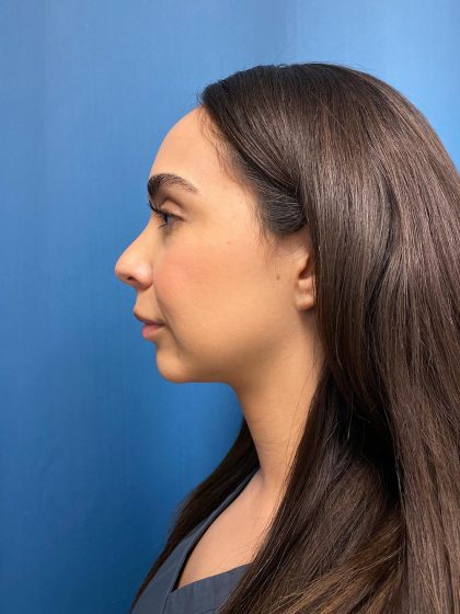 Lip Lift Before & After Patient #13215