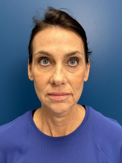 Facelift and Necklift Before & After Patient #13173