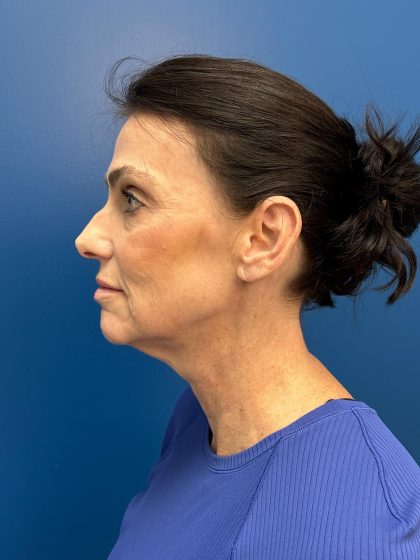 Facelift and Necklift Before & After Patient #13173