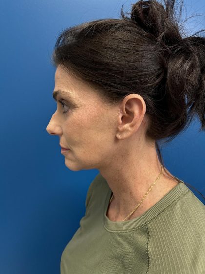 Facelift and Necklift Before & After Patient #13173