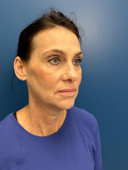 Facelift and Necklift Before & After Patient #13173