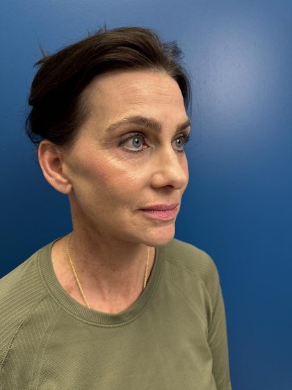 Facelift and Necklift Before & After Patient #13173