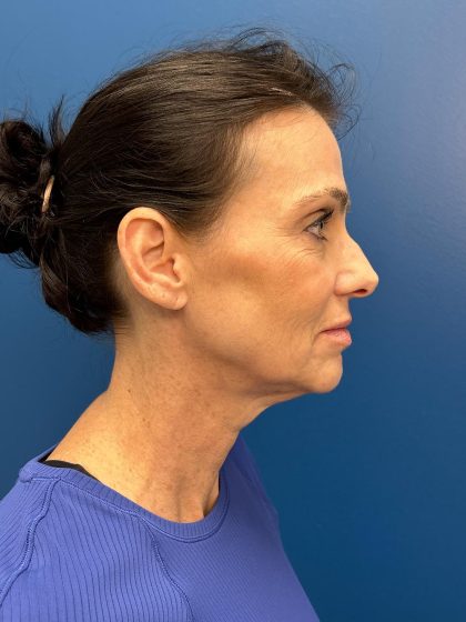 Facelift and Necklift Before & After Patient #13173