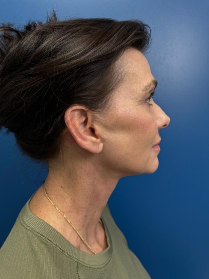 Facelift and Necklift Before & After Patient #13173
