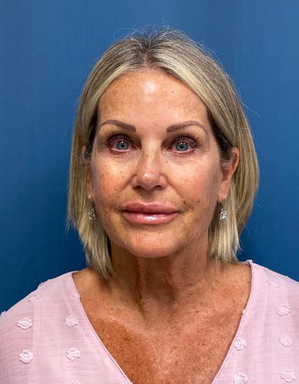 Facelift and Necklift Before & After Patient #13216