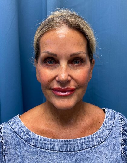 Facelift and Necklift Before & After Patient #13216