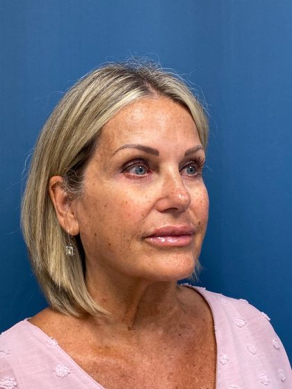 Facelift and Necklift Before & After Patient #13216