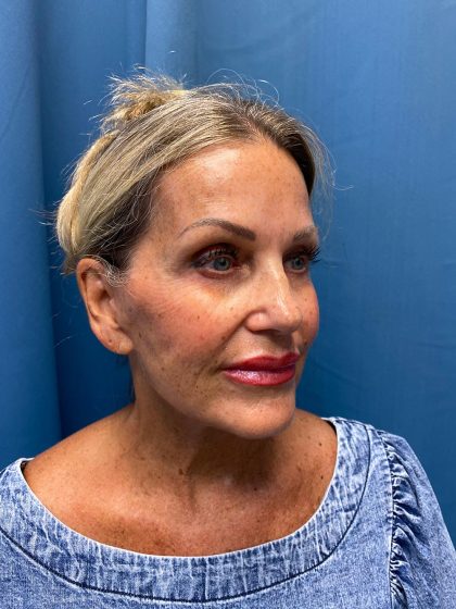 Facelift and Necklift Before & After Patient #13216