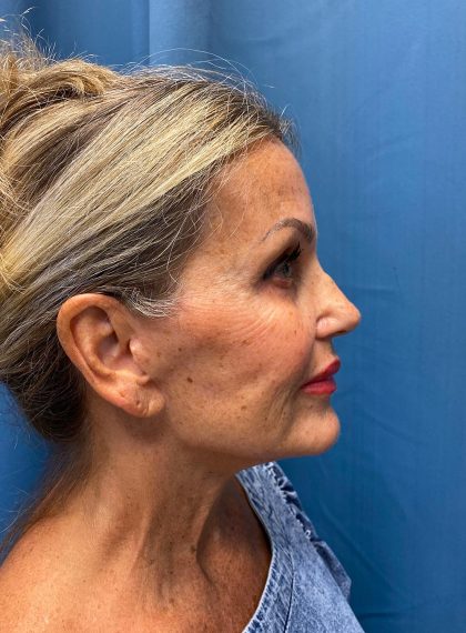Facelift and Necklift Before & After Patient #13216