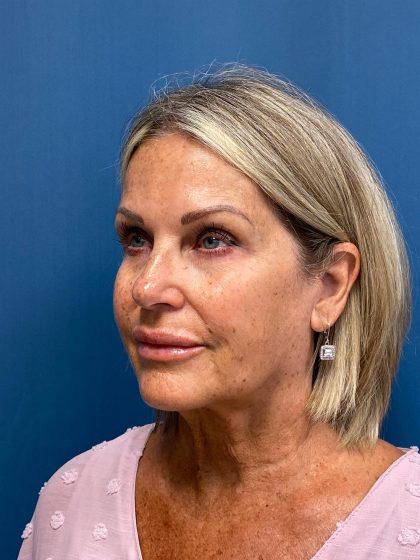 Facelift and Necklift Before & After Patient #13216
