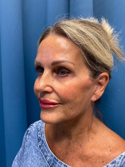 Facelift and Necklift Before & After Patient #13216