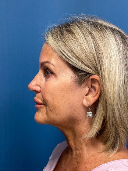 Facelift and Necklift Before & After Patient #13216