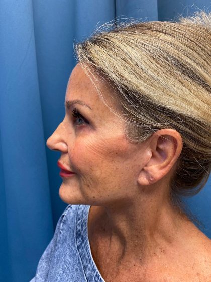 Facelift and Necklift Before & After Patient #13216